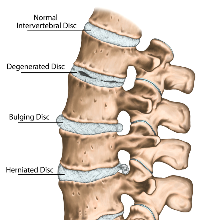 Disc Bulge, Disc Herniation, Degenerated Disc, Low back pain, Neck Pain, Portland Physical Therapy