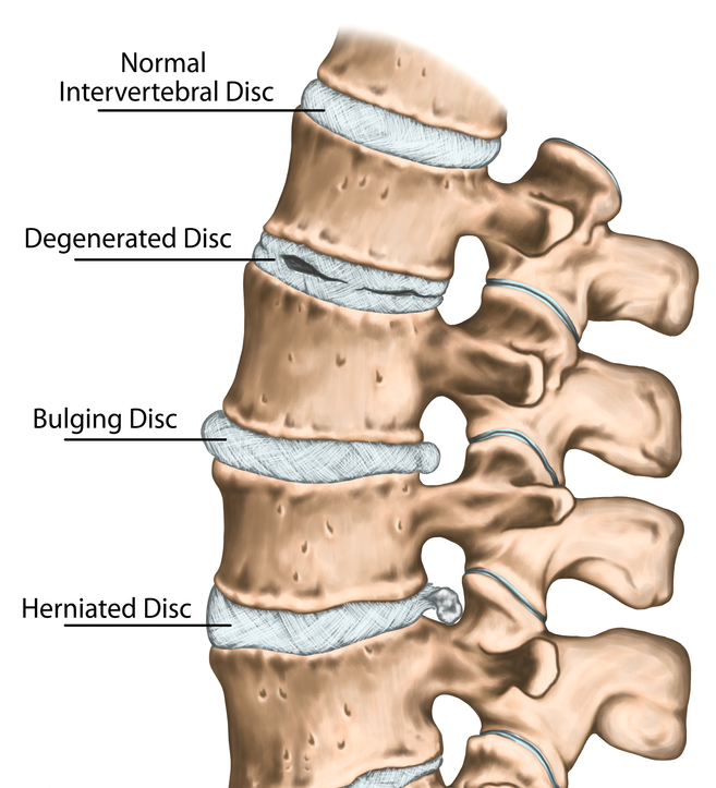 Disc Bulge/Herniation Portland Physical Therapy