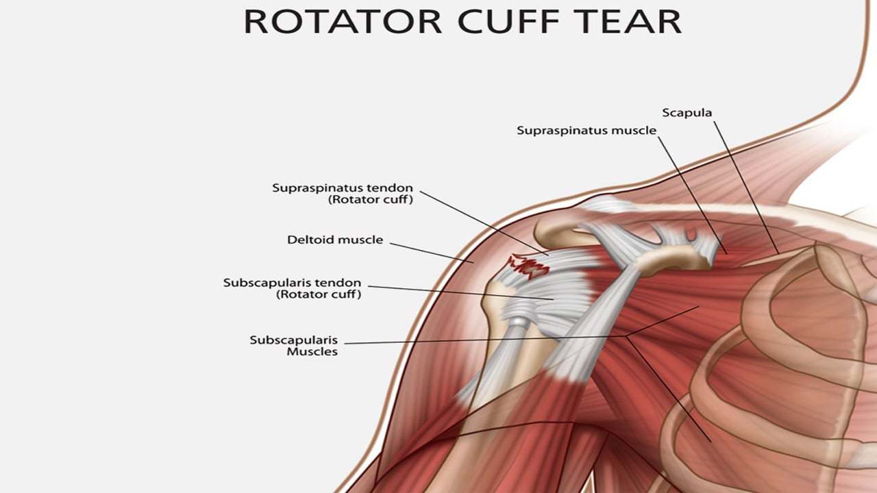 Anatomic description of degenerative rotator cuff tear. The common site